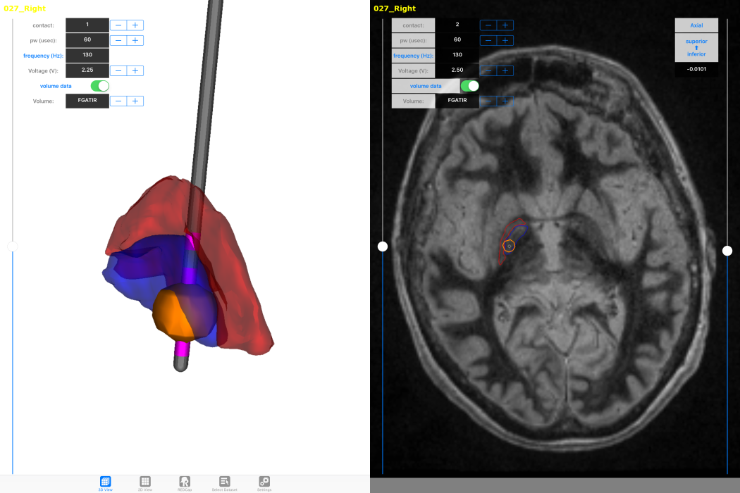 Deep brain stimulation image