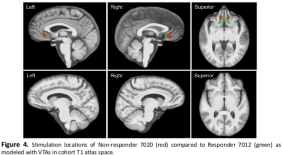 Deep brain stimulation for treatment-resistant depression